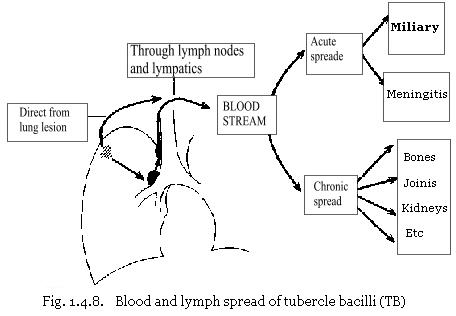Blood and lymph spread of tubercle bacilli (TB)