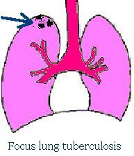 Focus lung tuberculosis