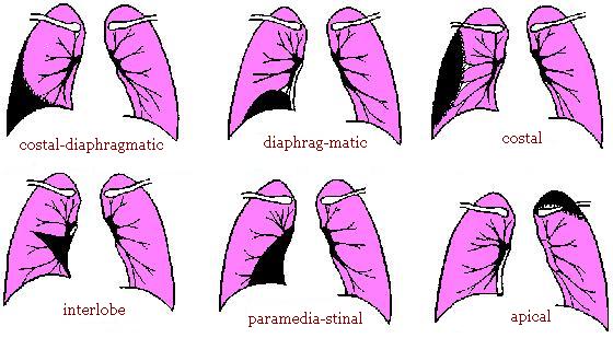 Pleurisy