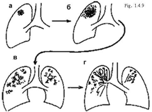 Evolution of secondary tuberculosis