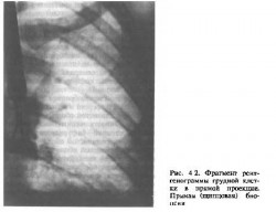 рентгенограмма грудной клетки